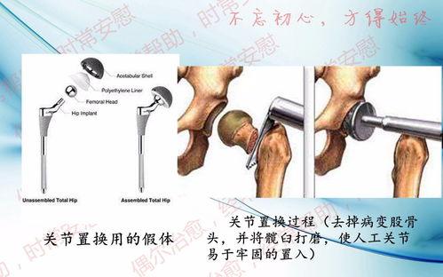 髋关节康复锻炼的视频,视频教程详解与实操步骤
