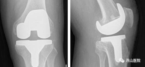 膝关节置换视频,从术前准备到术后康复